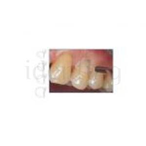 MATRICES CERVICALES LM p/incisales 60 ud